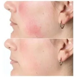 Silk'n Facial LED Mask 100 FLM100PE1001 white — image 8